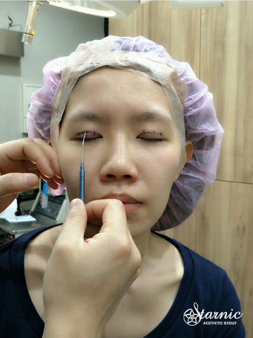 【縫雙眼皮手術】星和診所/台中醫美-就從今天丟掉雙眼皮貼，給我一雙對稱的雙眼皮-Yulia