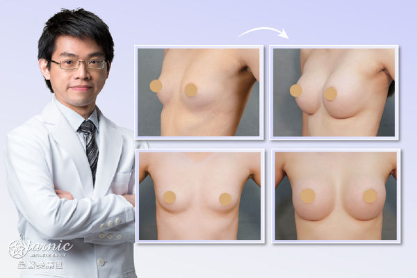 【果凍矽膠隆乳】星采大安／邱大睿醫師－給妳名模般的完美胸線！