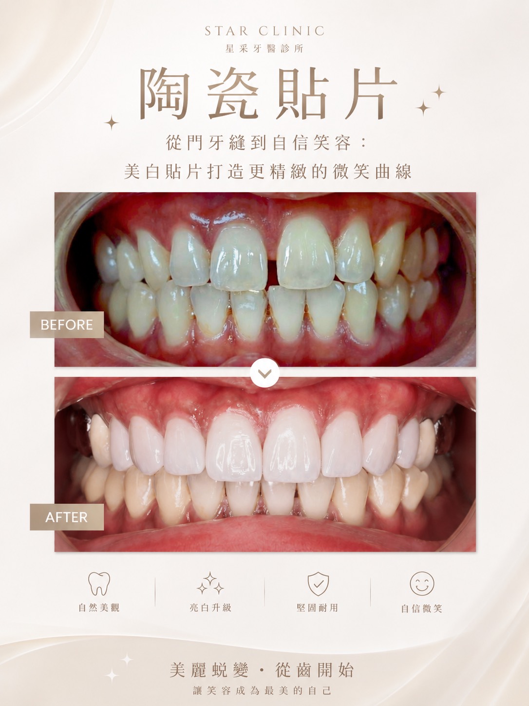 【陶瓷貼片】星采牙醫診所-王珮伊醫師-從門牙縫到自信笑容：美白貼片打造更精緻的微笑曲線