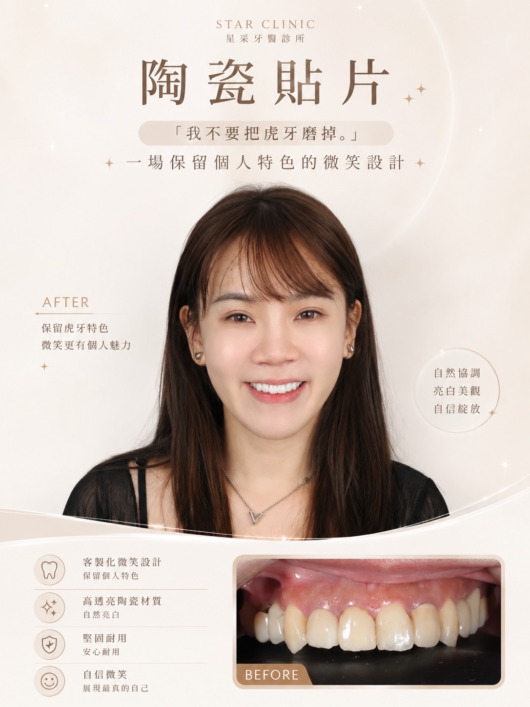 【陶瓷貼片】星采牙醫診所-王珮伊醫師-「我不要把虎牙磨掉。」，一場保留個人特色的微笑設計