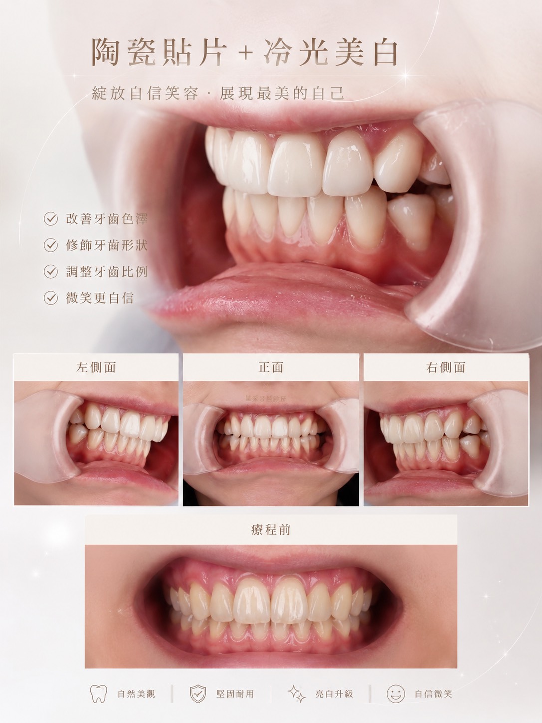 【陶瓷貼片+冷光美白】星采牙醫診所-王珮伊醫師-她不是想要一口「很白」的牙齒，而是想找回屬於自己的笑容