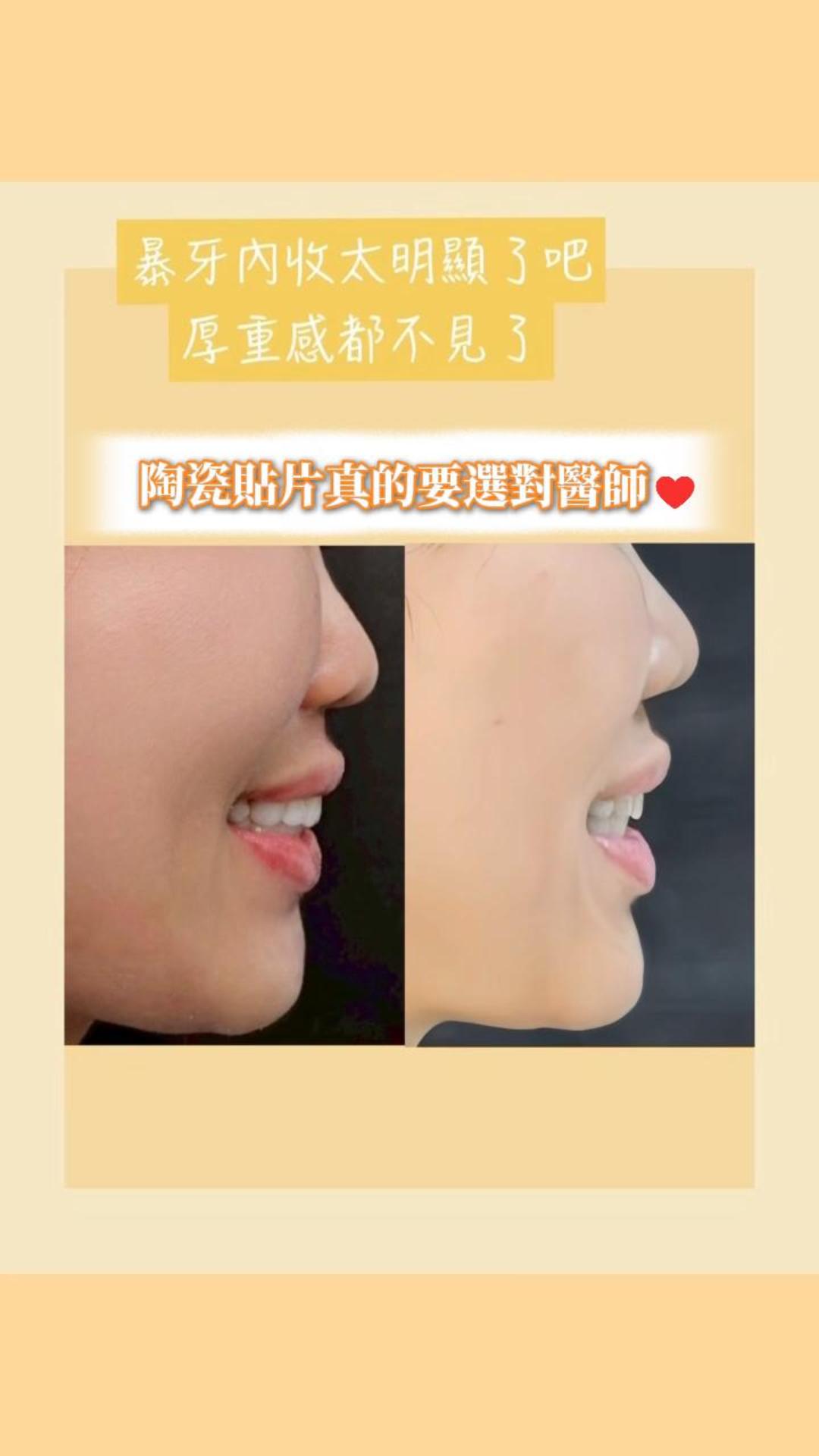 【陶瓷貼片】星采牙醫診所-王珮伊醫師-換新貼片解決了嘴凸，新笑容質感真的好棒