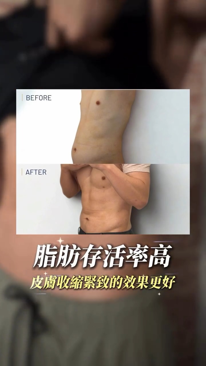 腹肌馬甲線輕鬆擁有！威塑二代抽脂打造完美腹肌與馬甲線