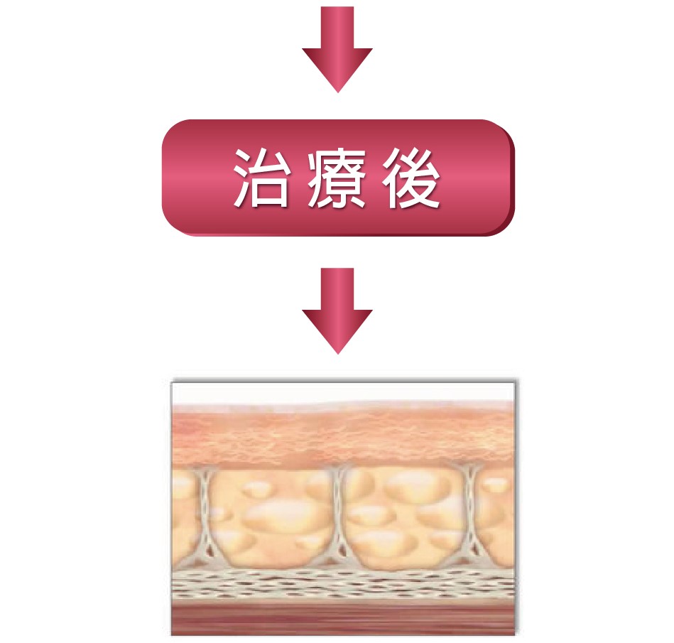 極線音波治療原理