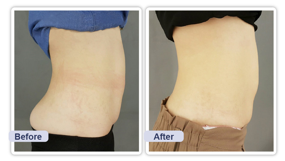 Btl Vanquish System 貝特爾高頻電磁場系統 台中醫美 台北醫美 非侵入式減脂 星采星和醫美 服務項目