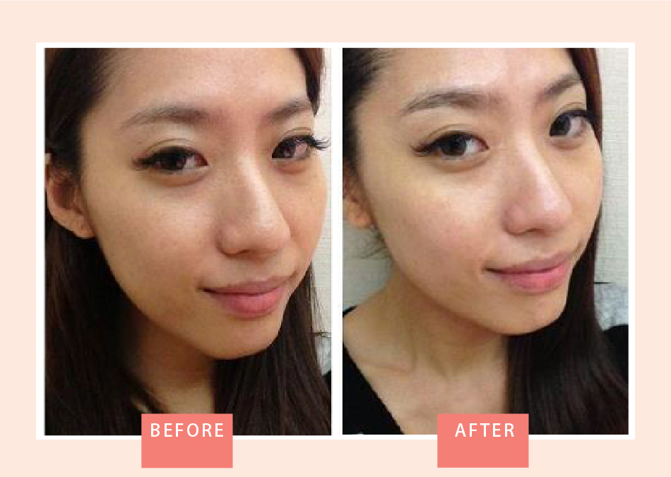 杏仁酸煥膚 去除老舊角質 淡化黑色素 人氣部落客推薦 星采星和醫美 服務項目