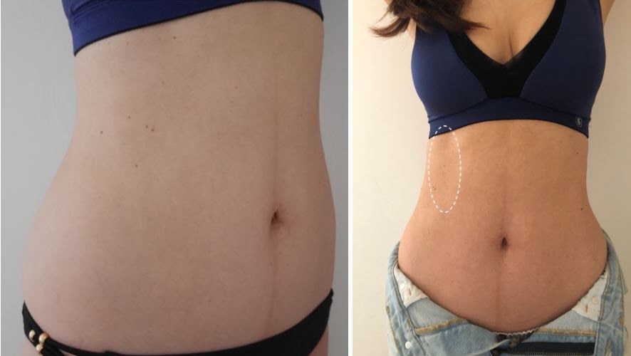 產後肚子鬆弛又消不下去 3分鐘了解瘦肚秘訣 擺脫小腹婆稱號 萬人好評