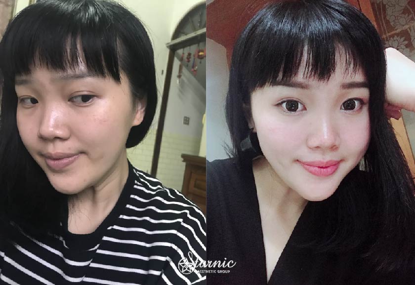 杏仁酸煥膚 敷面式離子導入 星和診所 高雄醫美 鄭玉貞醫師 痘痘 粉刺 毛孔不見 快速找回細緻美肌 Dolly