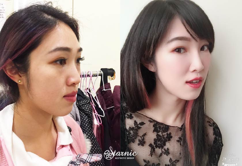 洢蓮絲蘋果肌 玻尿酸淚溝 鼻子 星和診所 桃園醫美 葉姿辰醫師 打造精緻立體感 Q彈小蘋果 Zona 萬人好評