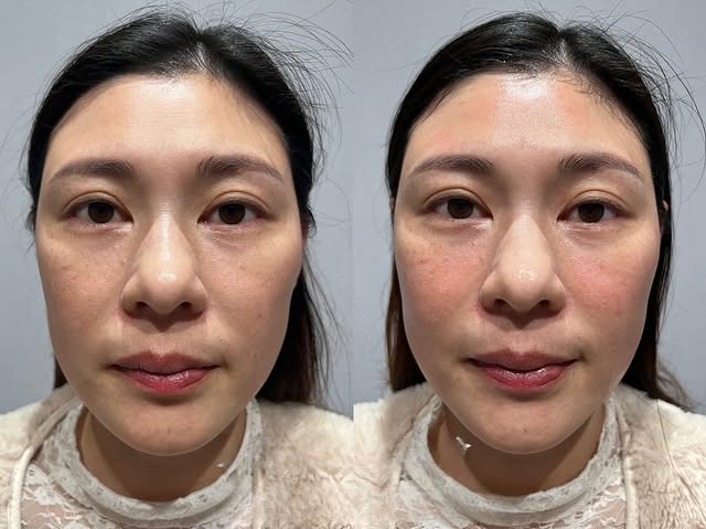 雕塑身材總是很難減掉臉頰的肉