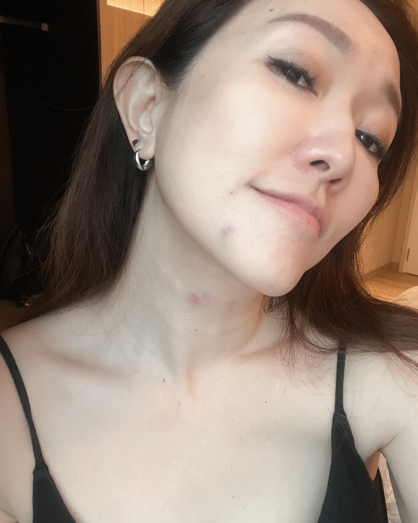 我試了 #瑞士IBSA製藥公司研發的美麗醫美療程——Profhilo逆時針！