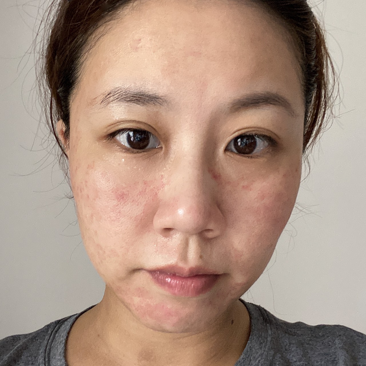 【皮秒雷射】仁愛星和診所-喜歡一個人時，感情被戴上了放大鏡。_羅珮瑜(小瑜星座)