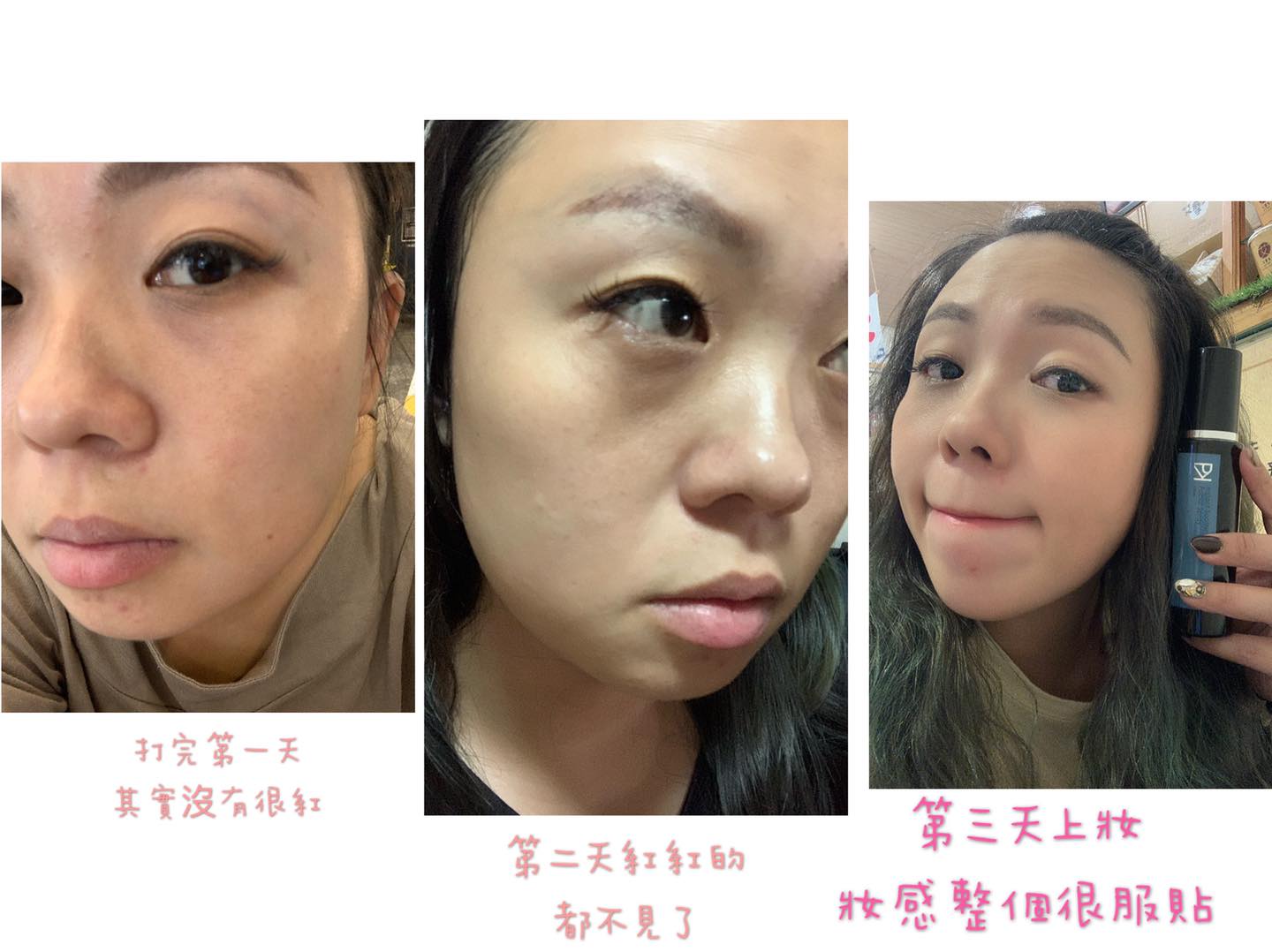  【皮秒雷射】星和診所-台南市-周顥洋 醫師-皮秒打完膚色變明亮!-八字眉芯芯 台南。美食。旅行
