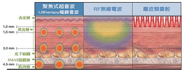 描述: 極線音波拉提04