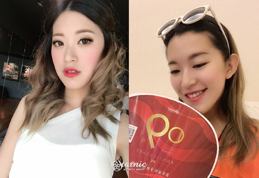 台南醫美星和診所_玻尿酸蘋果肌_Ting Wang王婷