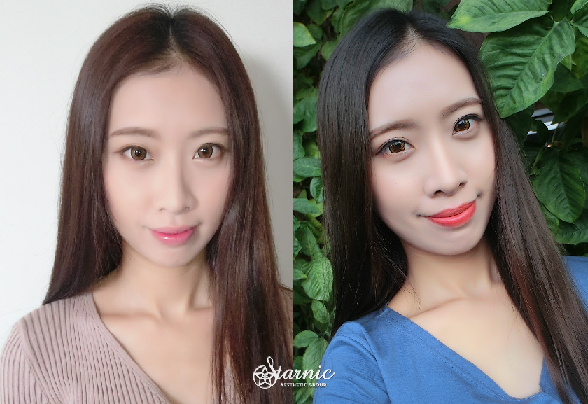 高雄醫美星和診所_玻尿酸墊下巴+肉毒放鬆下巴肌肉_蘇苾瑜