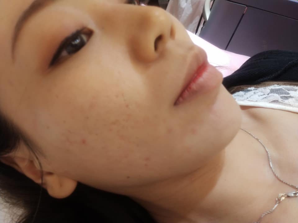 【皮秒雷射】星和診所-高雄市 賴衍翰醫師-皮秒雷射亮白系列,給你皮膚光滑細緻-E girl 小依