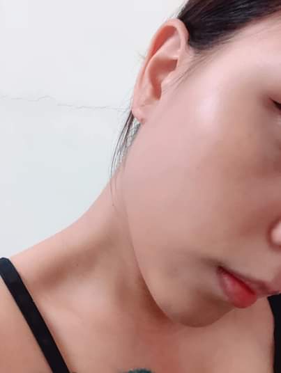 【淨膚雷射】星和診所/台南醫美-女人就是要不斷的變美才不容易讓人看膩，尤其夏天陽光的毒辣！！～-林靜兒