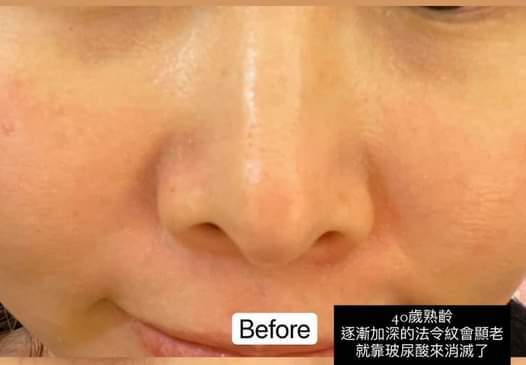 【玻尿酸】 年前就是要送自己變美，女神玻尿酸一隻解決法令紋!!!~ - 桃李漫天下