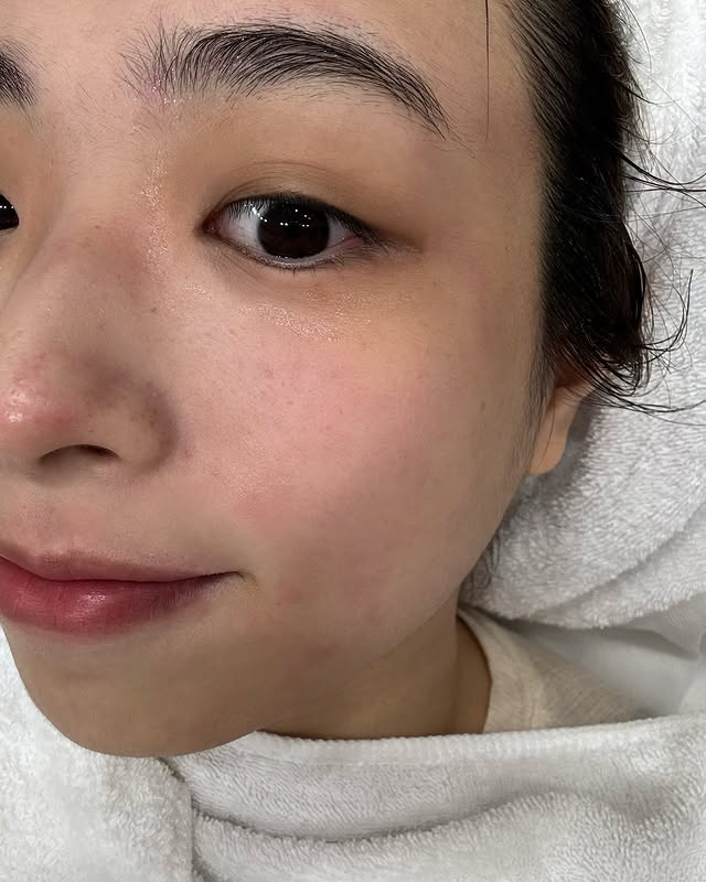 決定試試看皮秒雷射
