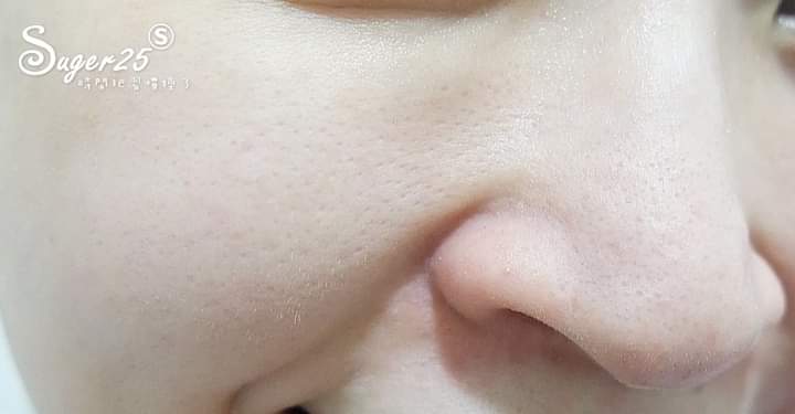 【淨膚雷射】星和診所/桃園醫-內外兼具雙管齊下~我的毛孔真的改善不少呢!! 醫美真的是讓人變美 ！！！~-Suger25 時間把習慣換了