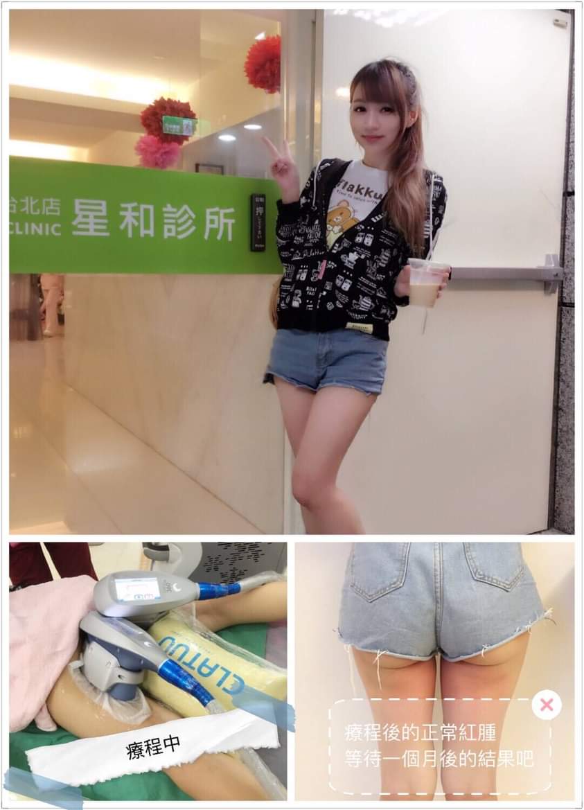 【冷凍減脂】非入侵的方式就可以消除脂肪 以前的腰有三個摺痕，現在明顯消失了！！-林虹伶〃Hongling Lin