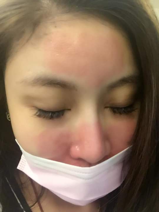 【飛梭雷射】 我的肌膚除了變細緻以外保養品也變得好吸收上妝後的膚質還是一樣的好！！～-Lia 甜芯