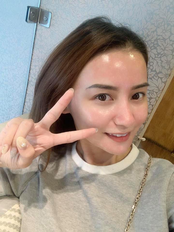 【皮秒雷射】 星和診所-台中市- 趙敏君醫師-趁空檔時刻快快預約雷射保養， 先來發一張高解析無碼，雷射後自拍照！！！-Vicki