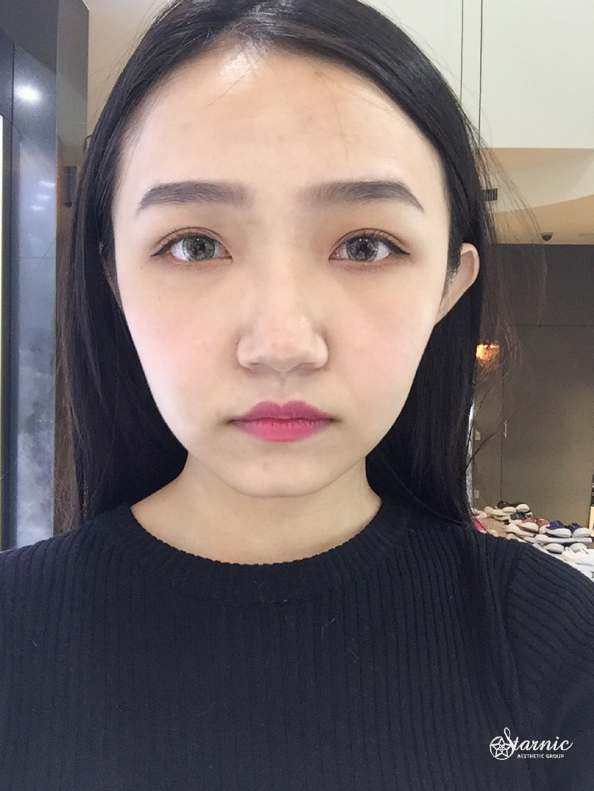 星和_Ulthera優珊納極線音波_蔡明薰02
