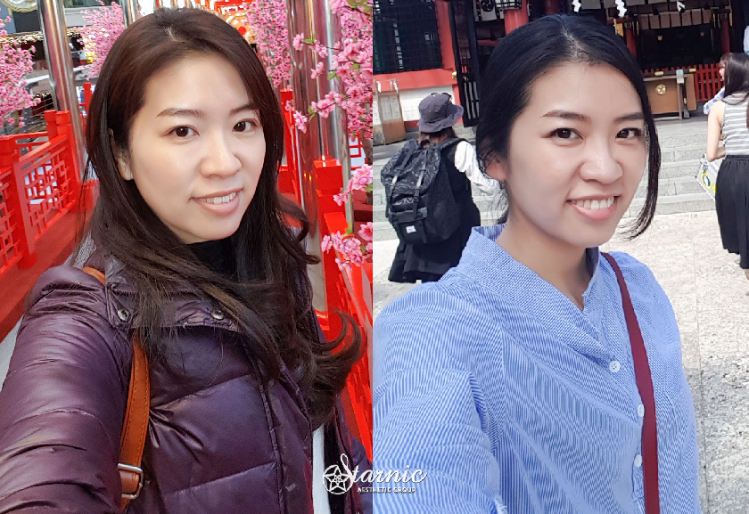 星和診所_Ulthera優珊納極線音波_張寒貞