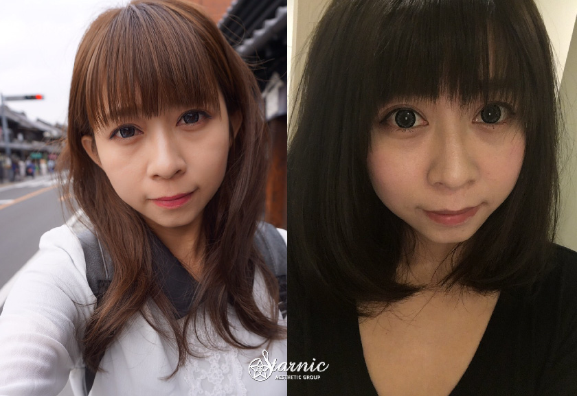 星和診所_玻尿酸填補淚溝、蘋果肌_金紫燕