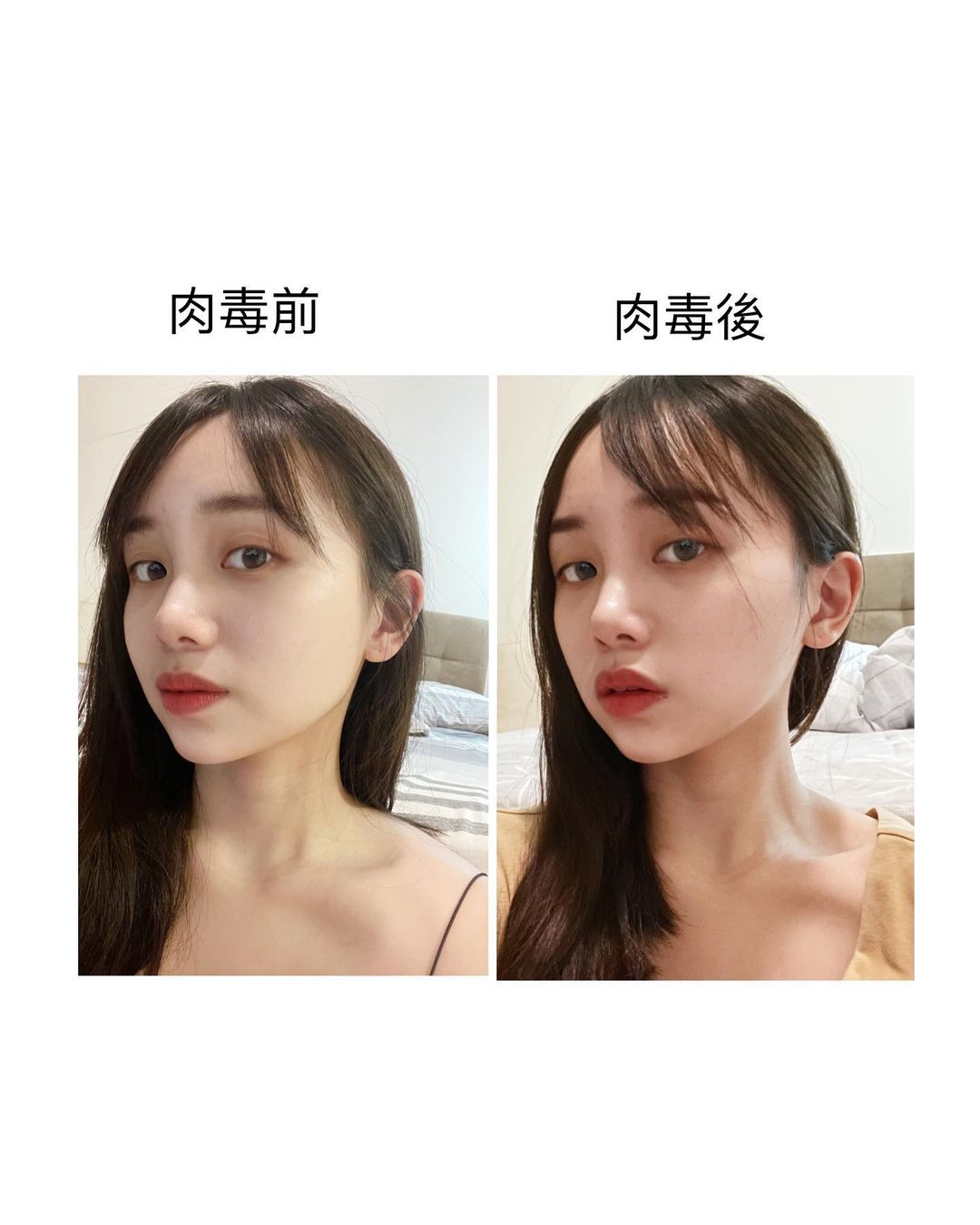 【肉毒桿菌】星和診所(新竹市)張惟皓醫師-真的是很快速就見效的方式!_花枝