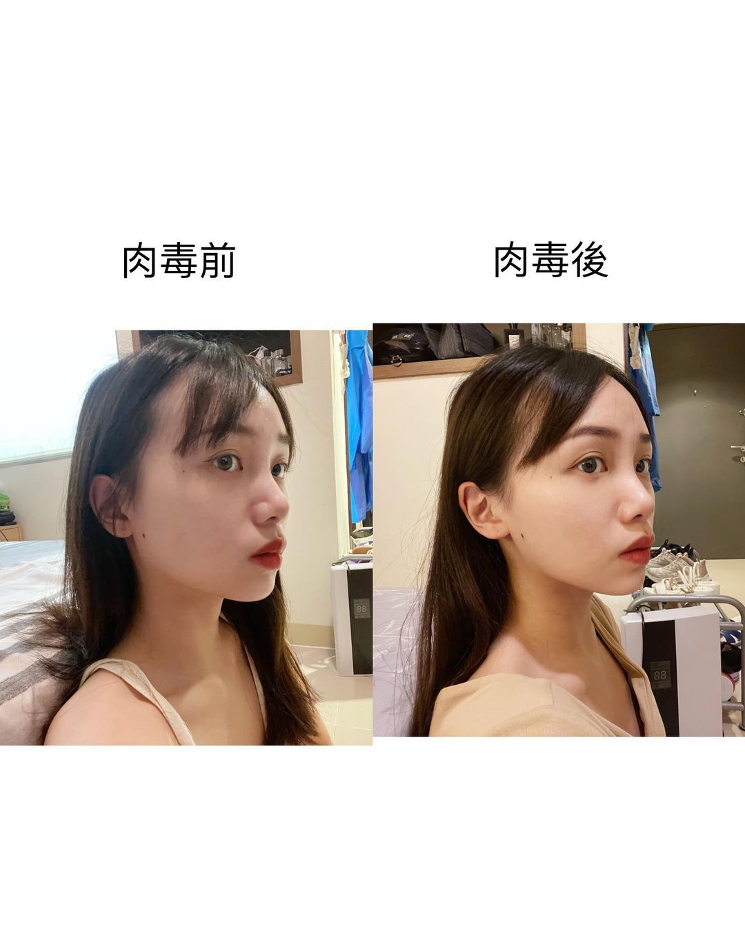 【肉毒桿菌】星和診所(新竹市)張惟皓醫師-真的是很快速就見效的方式!_花枝