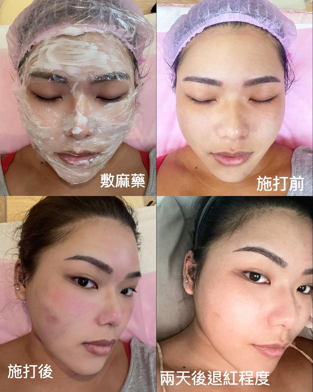 【皮秒雷射】星采皮膚專科診所 (古亭)- 洪曼珊醫師-想想即使色素上去也沒辦法改善唇色不均而且擦唇彩也會影響，結果上網查了一下是可以雷射改善的！所以就請醫師連我的嘴唇一起施打了！！-Sylvia Lee