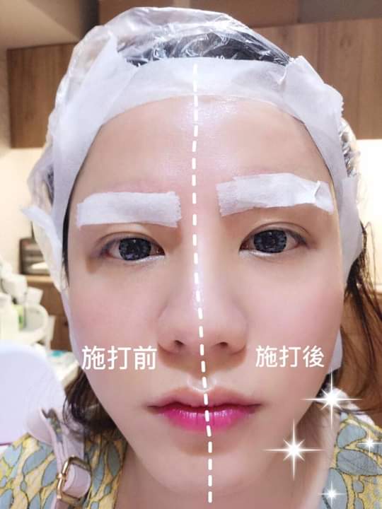 【皮秒雷射】星和診所/台中醫美-就算素顏不怕爛爛的皮膚了-Shin Shin