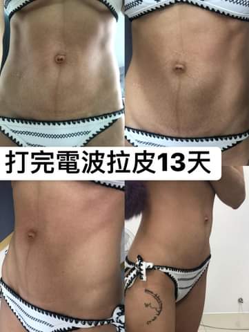 【電波拉皮】穿緊一點的褲子肚子也不會被擠到皺皺的，打完一個月真的有差！！！～-布小丁