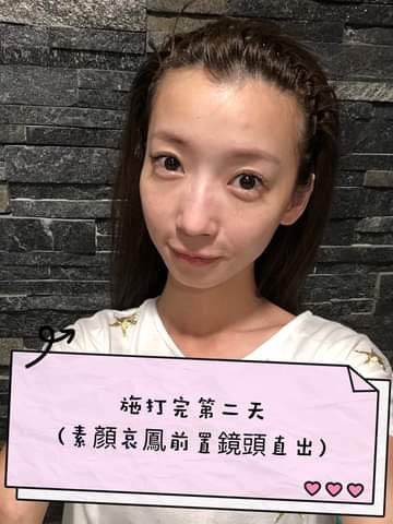   【皮秒雷射】仁愛星和診所/東區醫美-武洵白醫師-真的比清粉刺還「不痛」！！！-芳小如