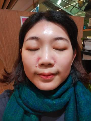 【皮秒雷射】星和診所/台中醫美-皮秒雷射勝過一堆昂貴淡斑產品-主持人Kira 評姊兒