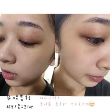 【飛梭雷射】 為什麼那麼愛打雷射呢?因為真的很有感啊每次打完結痂掉了都會覺得自己臉亮了！！～-黃悄悄