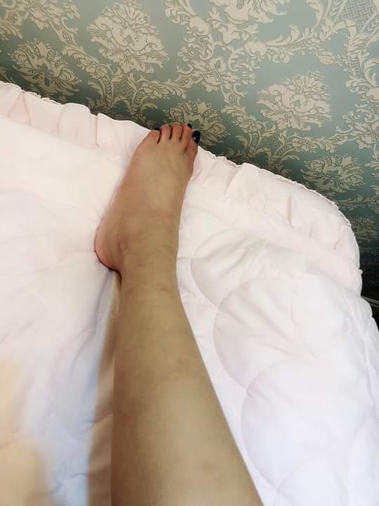 【淨膚雷射】星和診所/仁愛醫美-擺脫紅豆冰腳，還我白皙美腿 ！！～-Alison Yeh