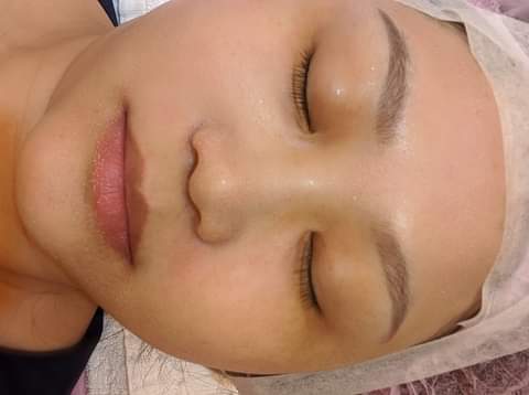 【飛梭雷射 】女人總是想要自己的臉部看起來完美無瑕，為了淡化臉上的疤痕， 所以我到星和醫美診所做了飛梭雷射！！！！～-范范愛分享