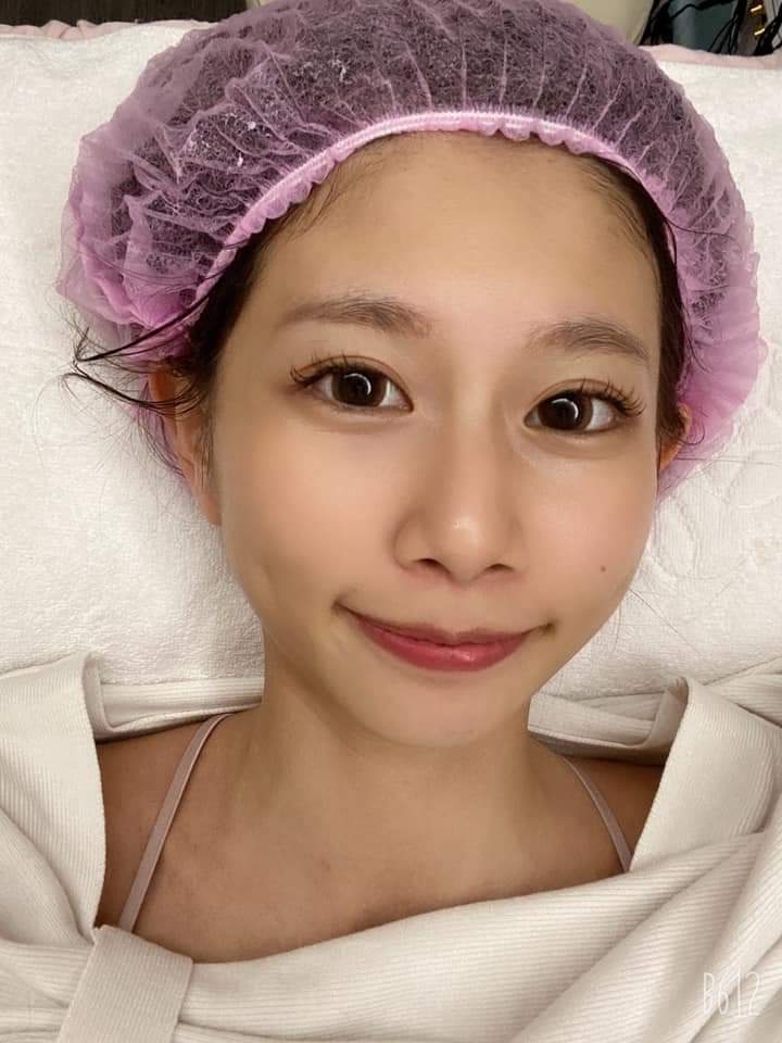 【杏仁酸煥膚】朵莉是屬於閉鎖式的粉刺，就是看似有但擠不出來（超討厭！）！！！❤❤ ~-朵莉去哪兒