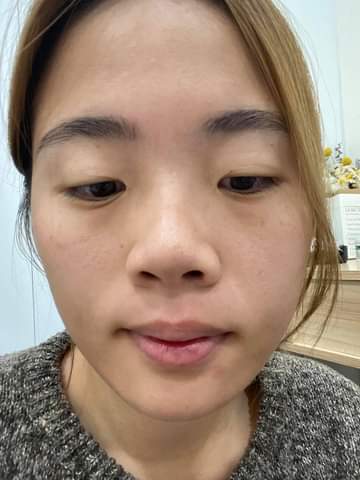  【皮秒雷射】星和診所/台中醫美-買保養品的錢，就可以拯救自己的毛孔和雀斑！ -山抓小姐的旅行攝