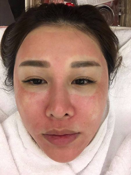 【皮秒雷射】過年可以美美見人啦