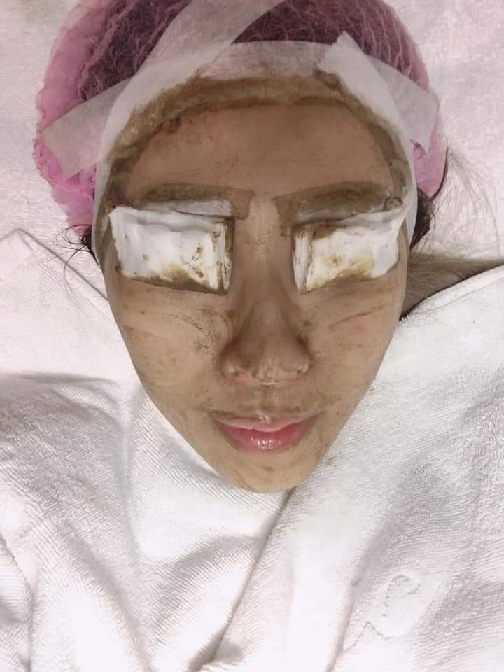 【杏仁酸煥膚】 藻針真的效果很棒很明顯推薦大家一定要來試看看 ▸海藻煥膚❤❤ ~-HuHu 林尹柔