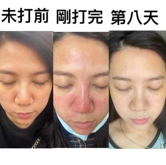  【皮秒雷射】星和診所/高雄醫美-皮秒雷射幫您開啟美肌模式-吳于琪