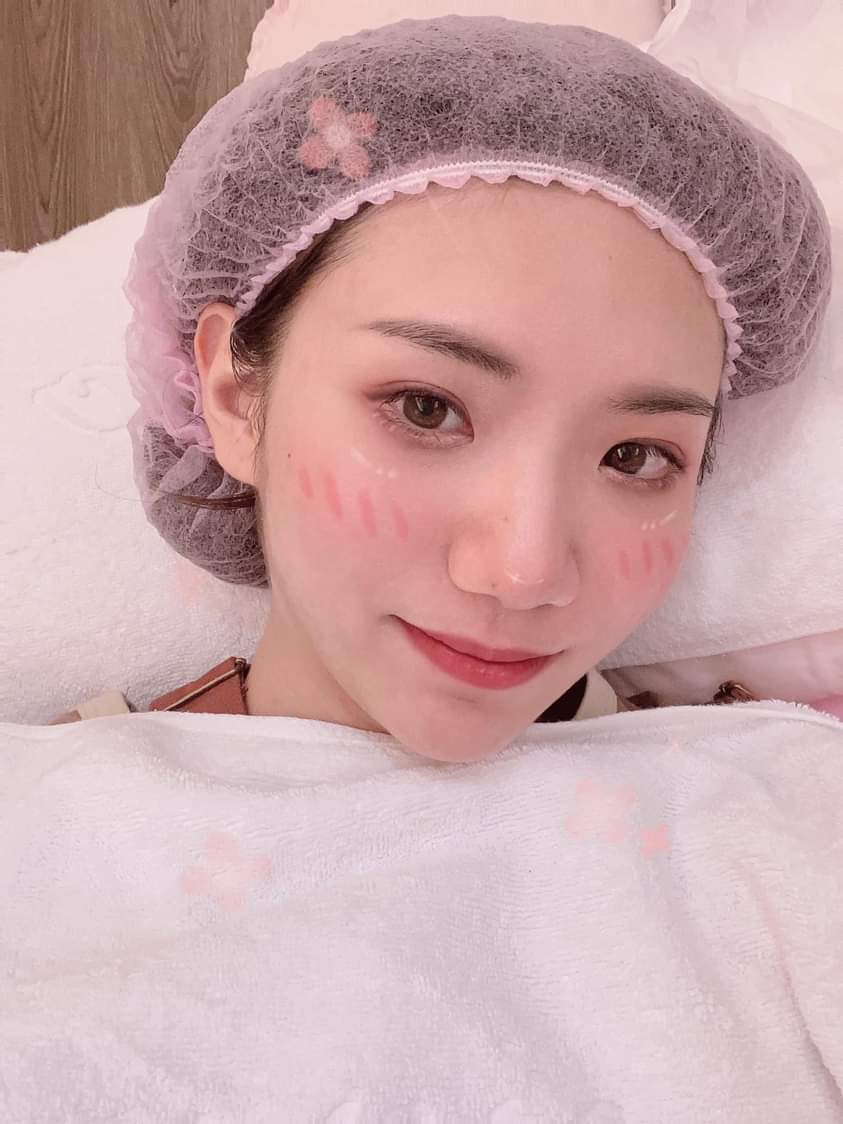 【美容療程-活力點滴】又來了每個月一次的保養杏仁酸，最近粉刺太多來清一下縮一下毛孔❤❤！！！-Guo Yuki