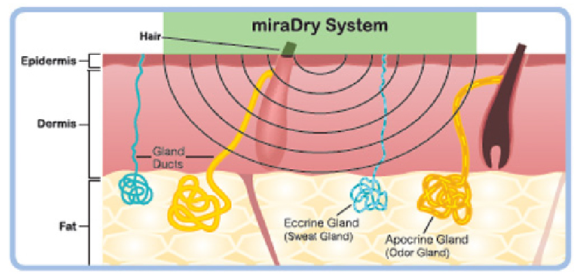 星采古亭_Miradry腋淨爽_葉姿辰醫師03