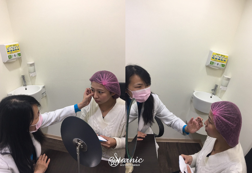 星和診所_玻尿酸填補淚溝、蘋果肌_金紫燕