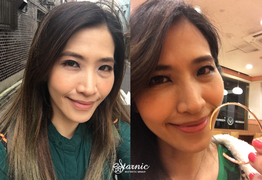 星采整形外科診所(大安)_縫雙眼皮手術_梁一貞
